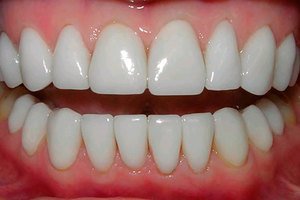 Особенности люминиринга зубов