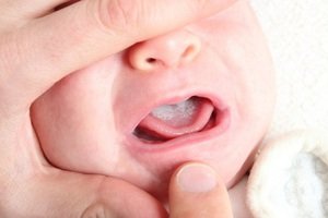 Как лечить кандидоз в полости рта