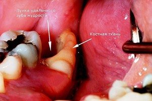 Удаление зуба - болезненные ощущения