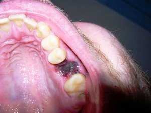 Кровяной сгусток в лунке после удаления зуба — фото