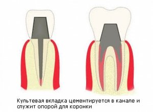 Зубные вкладки под коронку: культевая вкладка на зуб