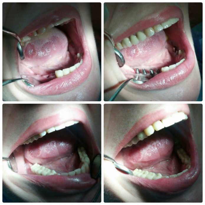 Установка протезов на жевательные зубы