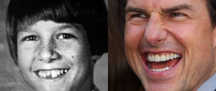 Зубы Тома Круза до и после