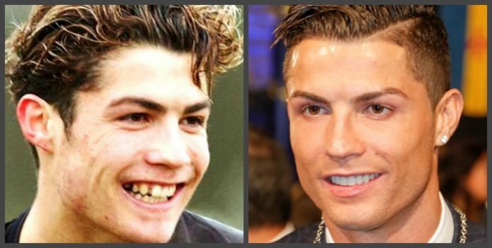 Зубы Криштиану Роналду до и после