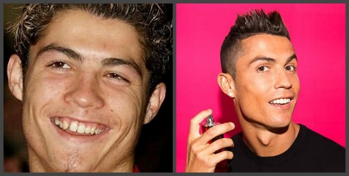 Зубы Криштиану Роналду до и после