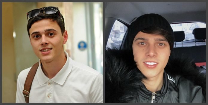 Алексеев зубы до и после