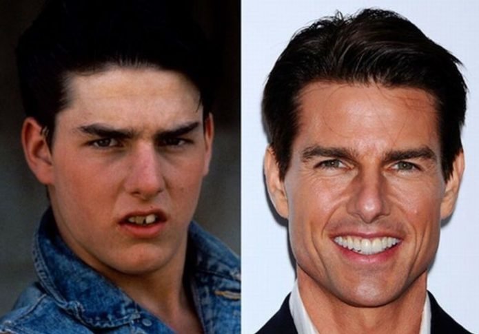 Зубы Тома Круза до и после