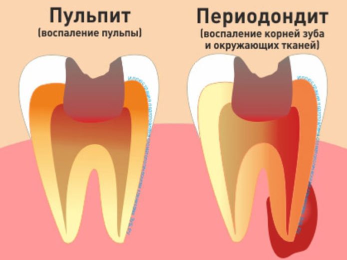 Болезни зубов