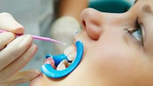 Особенности серебрения молочных зубов у детей