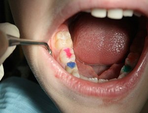 Преимущества и недостатки серебрения и поломбирования зубов детям