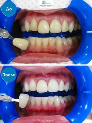 Процедура по отбеливанию зубов Air Flow