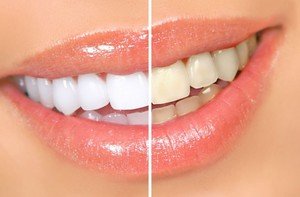 Чем отбеливать зубы в домашних условиях