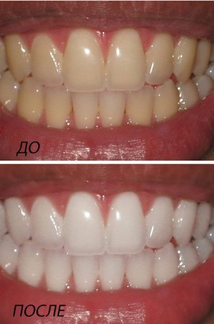 Технология отбеливания зубов