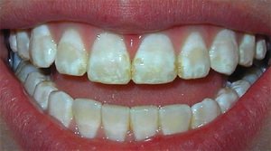 Причины повреждения зубной эмали