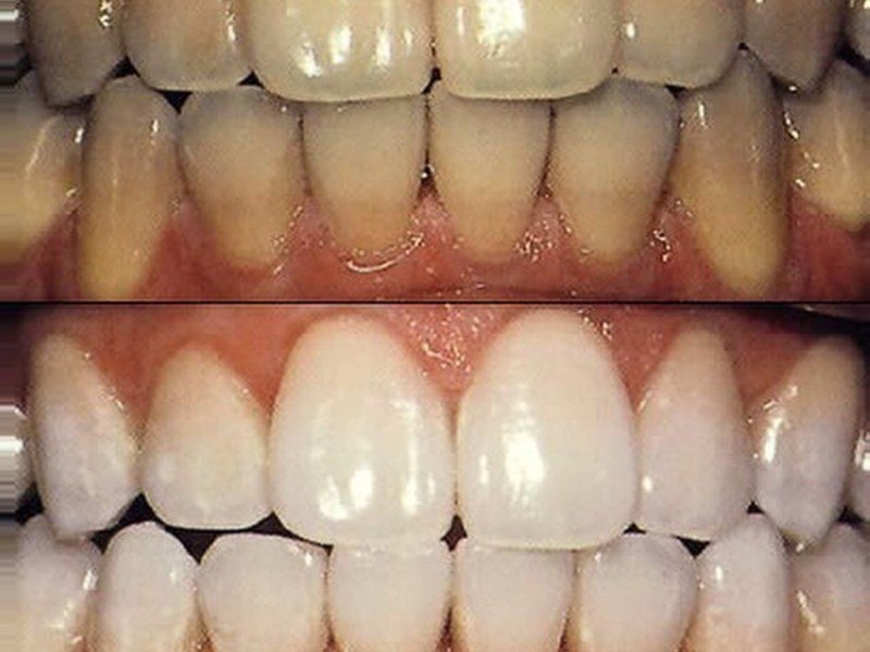 Как ухаживать после отбеливания зубов