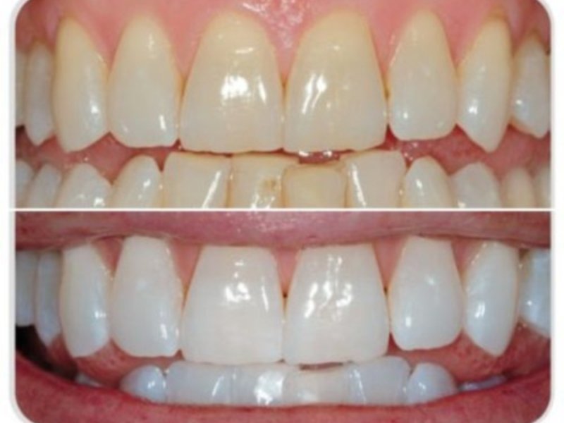 Эффект после отбеливания зубов