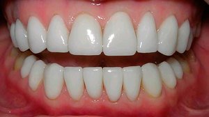 Особенности люминиринга зубов