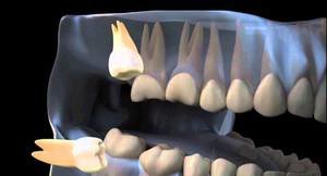 Удаление зуба мудрости: последствия, и как их избежать