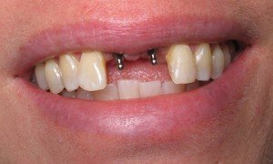 Описание процедуры установки имплантов зубов