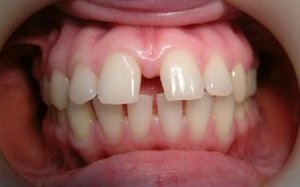 Описание относительных ограничений для имплантации зубов