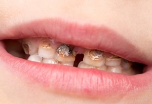 Перечень временных и местных ограничений для имплантации зубов
