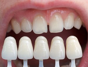 Описание видов протезирования зубов