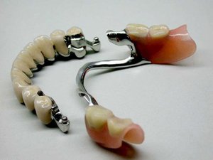 Особенности конструкции бюгельных зубных протезов
