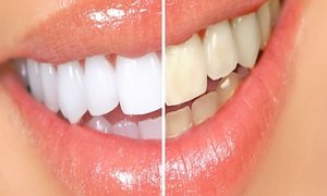 Описание принципа действия отбеливающих полосок для зубов