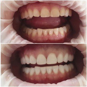 Как проволится процедура отбеливания зубов