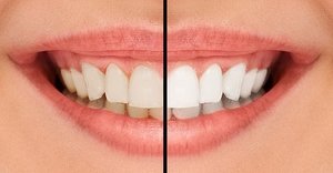 Как возможно отбелить зубы