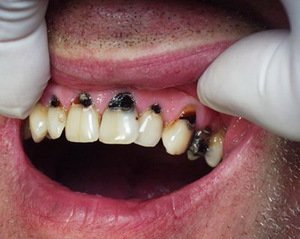 Из-за чего появляется кариес зубов