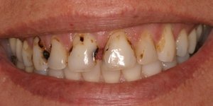 Участки зубов, которые наиболее подвержены образованию кариеса