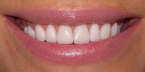 Эстетическая реставрация передних зубов: виды и преимущества, цена
