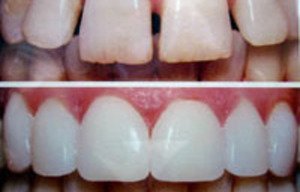 Коррекция передних зубов