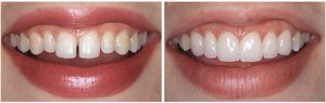 Показания к реставрации передних зубов