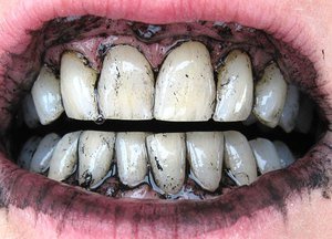 Активированный уголь в стоматологии
