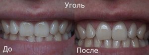 Отбеливание зубов - фото до и после