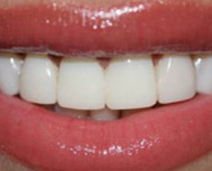 Плюсы и минусы зубных виниров