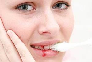 Кровоточивость при чистке зубов - это неприятный показатель наличия проблем с деснами.