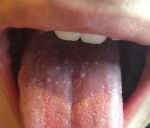 Аллергия на пищу может вызвать боли языка