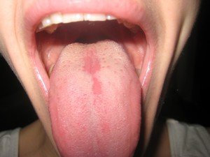 Как помочь себе, когда болит язык?