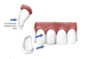Схема обработки зуба перед установкой винира у стоматолога