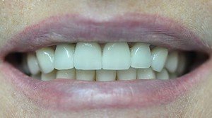 Керамические зубные коронки на зубах - неотличимы от настоящих зубов