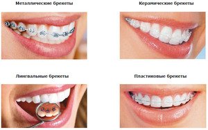 Как происходит протезирование зубов
