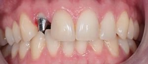 Циркониевые коронки - еще один вариант стоматологического материала