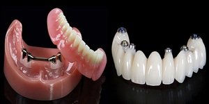 Типы зубных протезов и их характеристики