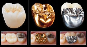 Характеристика разновидностей коронок для зубов