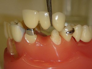 Характерное описание мостовидных зубных протезов