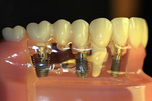 Свойства имплантов зубов и особенности процедуры установки