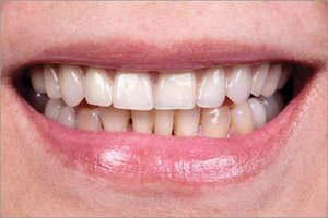 Причины гиперестезии зубов